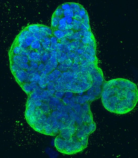 Учёные выявили белок, препятствующий распространению метастаз при раке груди