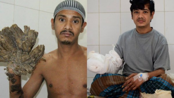 «Человек-дерево» попал в больницу Бангладеша из-за критического ухудшения состояния