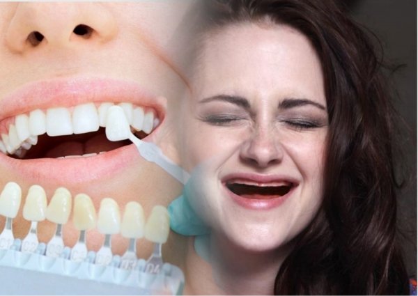 Пеньков полон рот: Любители «голливудской» улыбки остаются без зубов после установки виниров